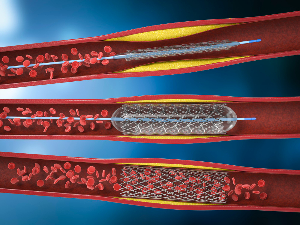 Ilustração para colocar stent