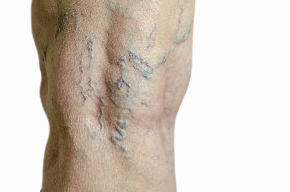 Perna com veias varicosas visíveis, destacando veias azuladas e dilatadas sob a pele.