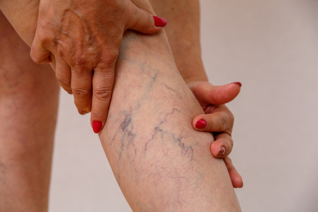 Pessoa com mãos apoiadas na panturrilha, evidenciando veias varicosas visíveis na pele.
