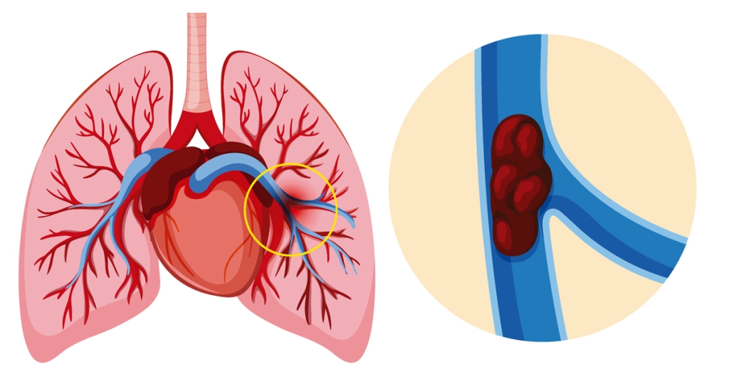 Quais são os sintomas da embolia pulmonar?